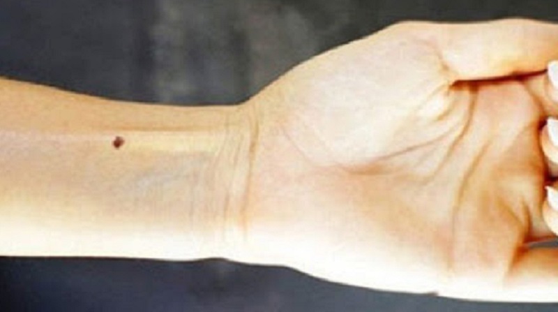 Ý nghĩa nốt ruồi ở cổ tay trái khác nốt ruồi ở cổ tay phải như thế nào
